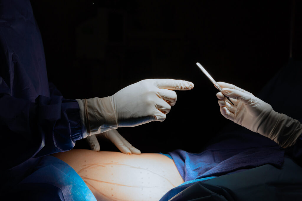 A surgeon's gloved hand reaches for a scalpe, while spotlighted below him is a patient's belly marked and ready for a stomach tuck. Soon this patient will get to have their own amazing tummy tuck before and after images in St. Lucie County.