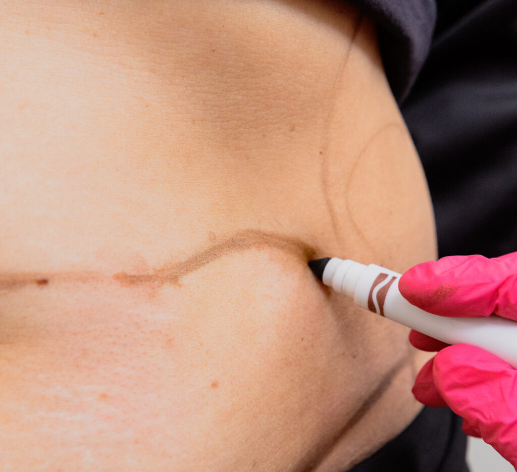 A provider draws on a patient's stomach to prepare them for a tummy tuck near Jupiter Island